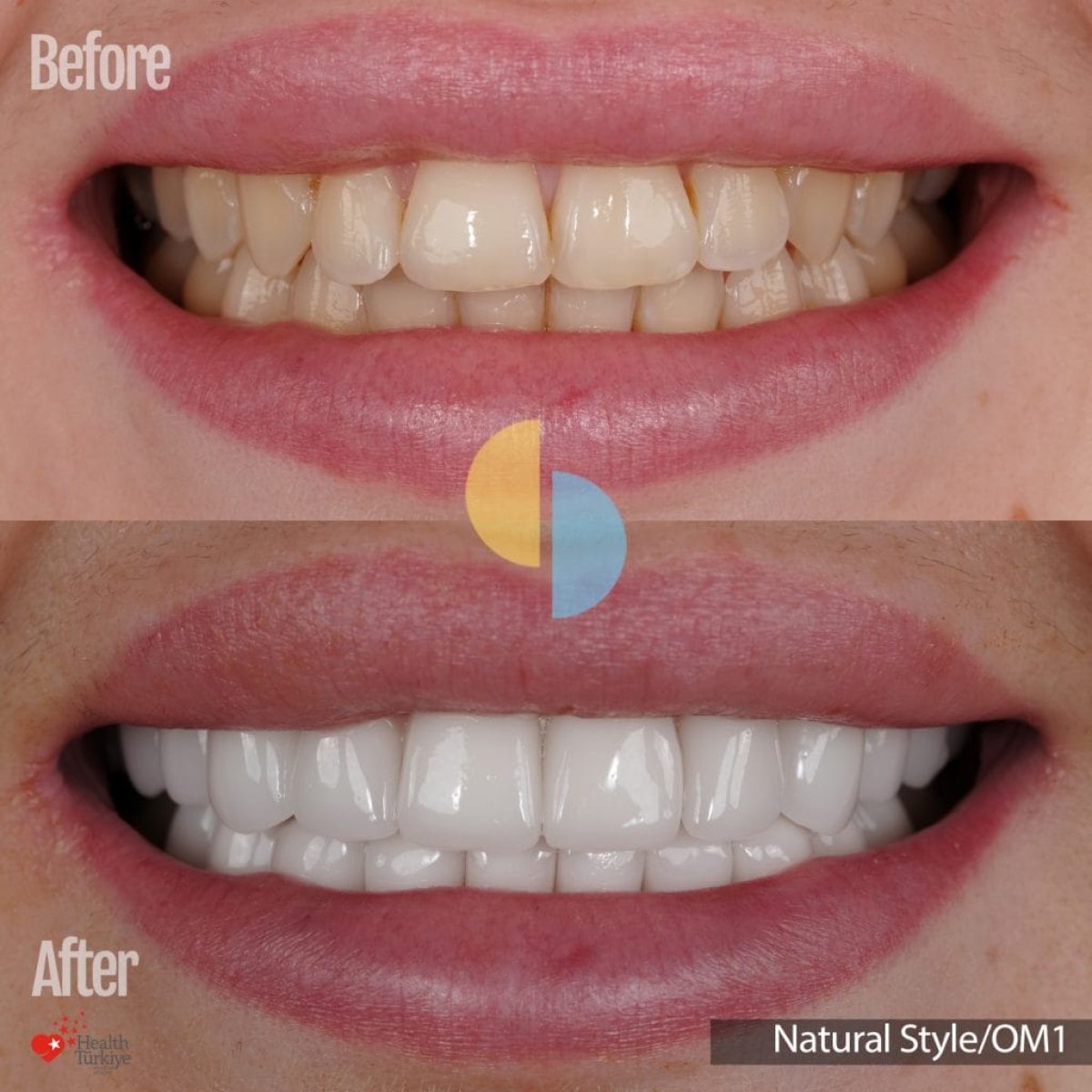 Resultados de carillas dentales en Health Turkiye: sonrisa más blanca y natural