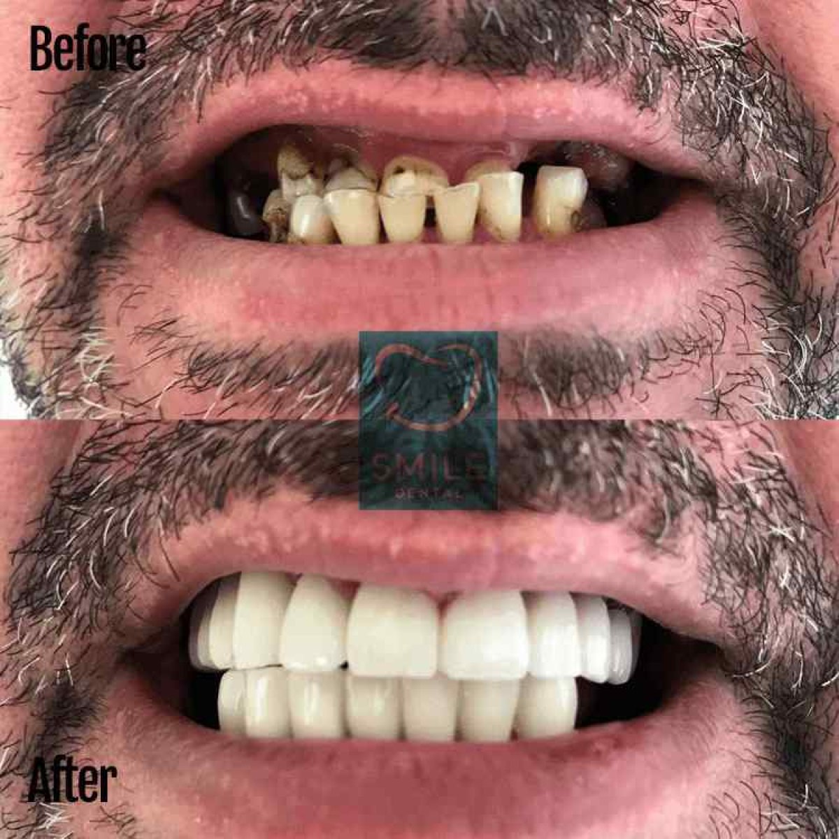 Vorher-nachher-Ergebnis Porzellankronen bei Smile Dental – wiederhergestelltes Lächeln