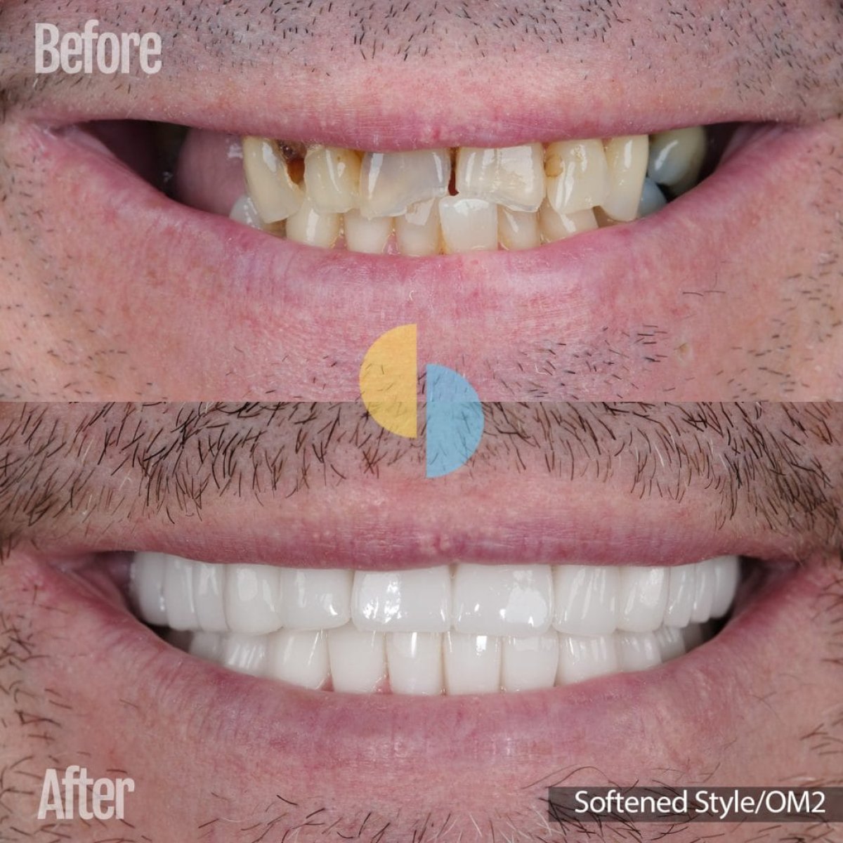 Before and after porcelain crown installation results – improved smile and whiter teeth