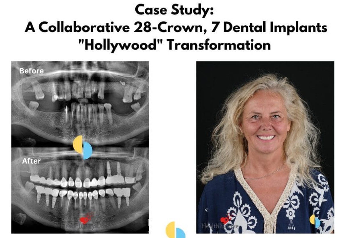 Before and after dental implants with crowns, full mouth restoration result at clinic