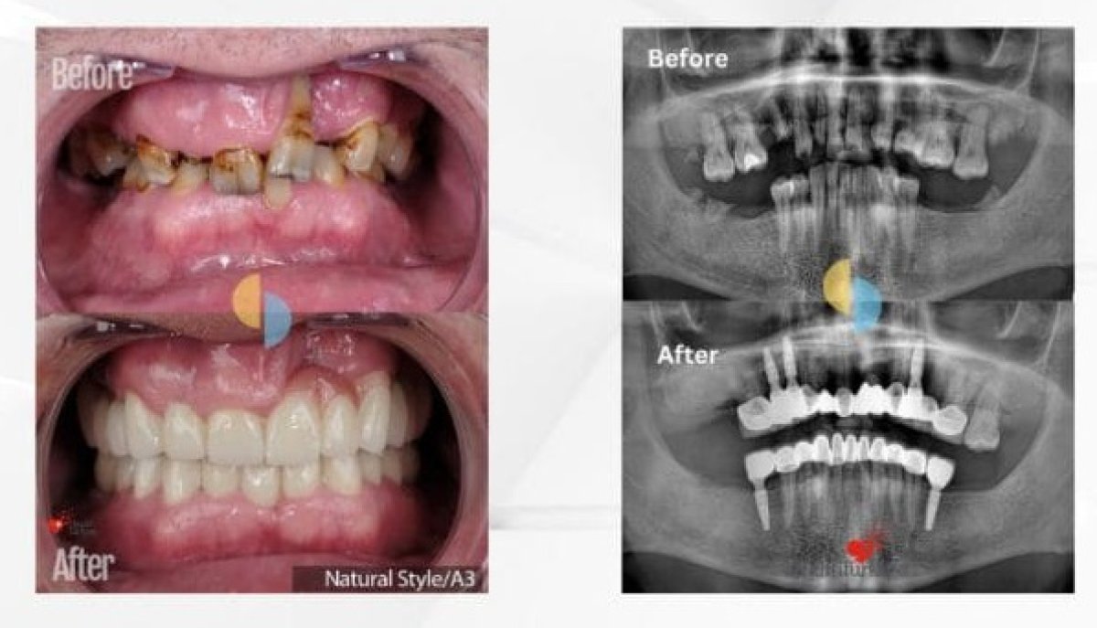 Before and after dental implant with crown results – restored smile and improved oral health