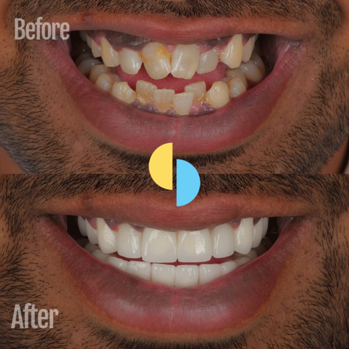 Before and after zirconia crown installation results – improved smile and whiter teeth