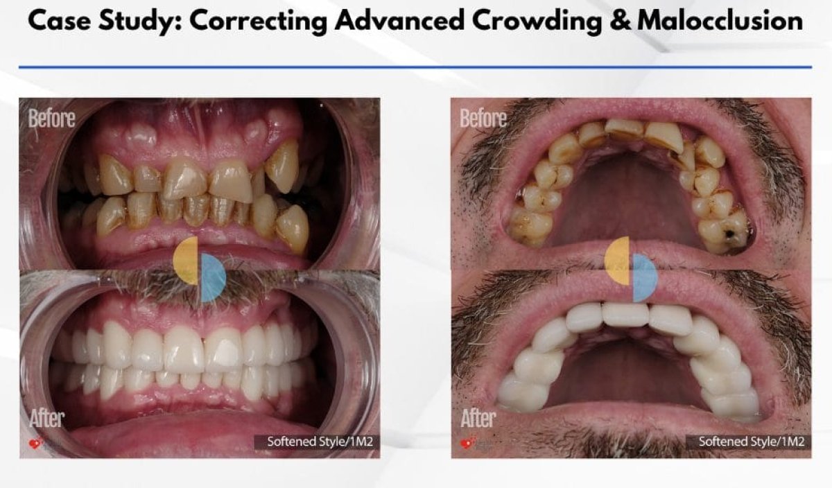 Before and after zirconia crown installation for advanced crowding and malocclusion correction result