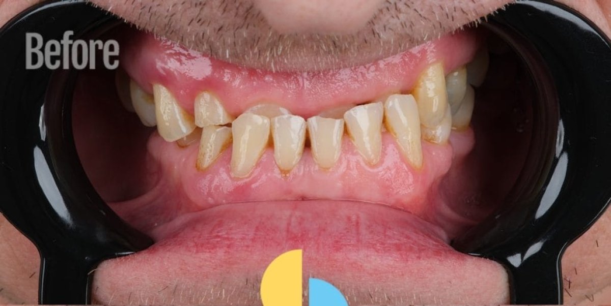 Résultat avant smile makeover – dents décolorées et mal alignées avant traitement dentaire