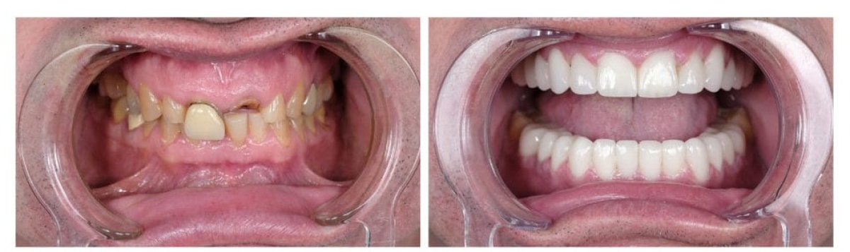 Результаты до и после smile makeover – восстановление зубов винирами и коронками