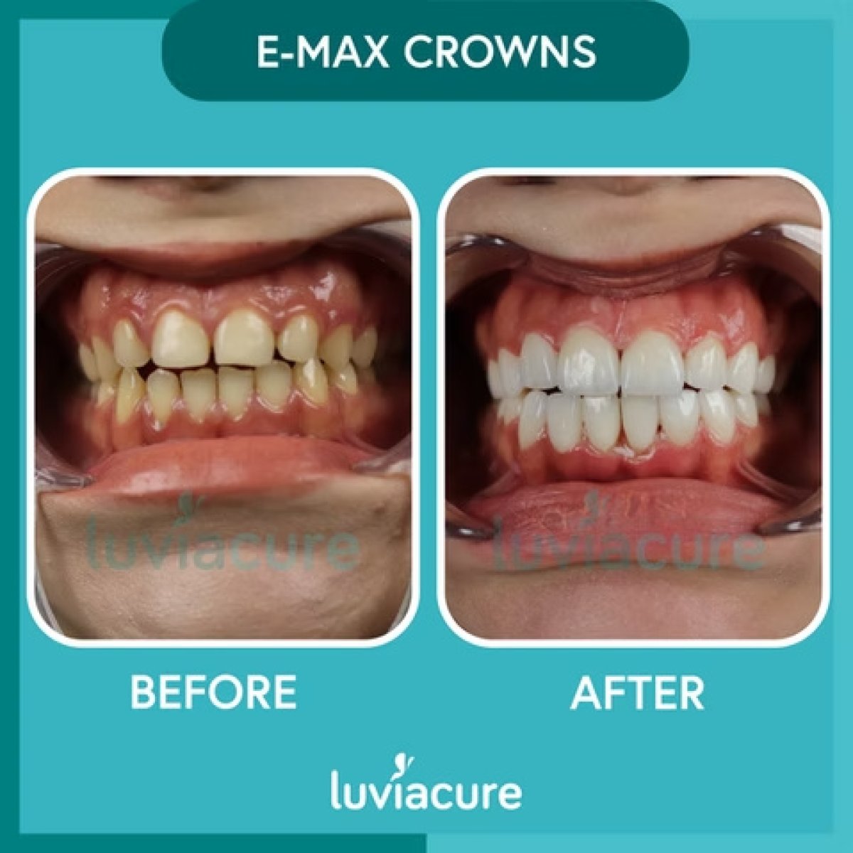 نتائج قبل وبعد تركيب تيجان E-max في Luviacure – ابتسامة طبيعية ومحسنة