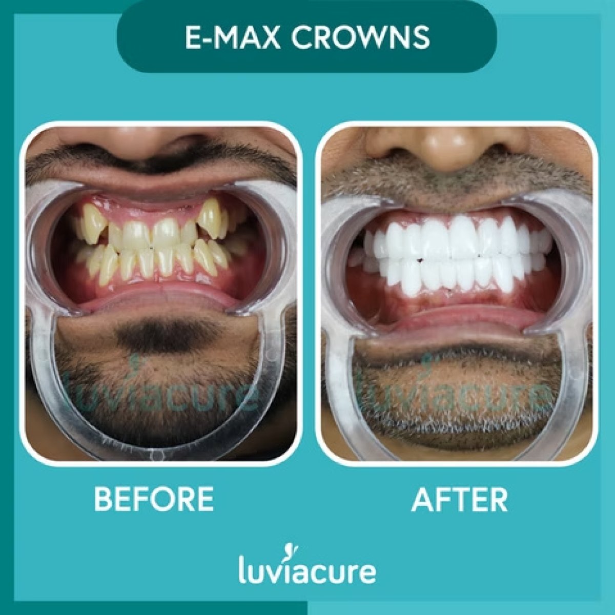 نتائج قبل وبعد تيجان E-max في Luviacure، تحول الابتسامة