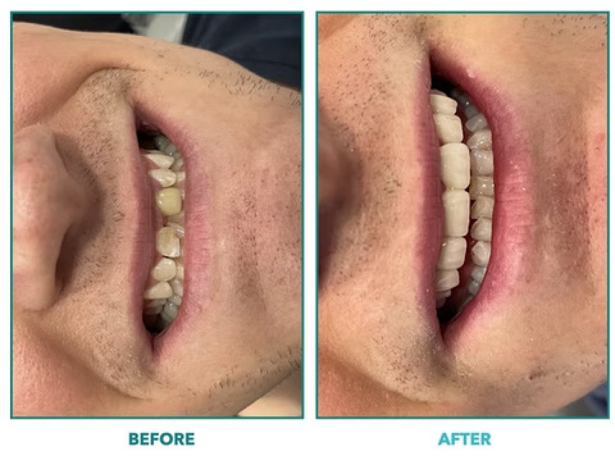 Before and after tooth whitening results – visibly brighter smile after dental procedure