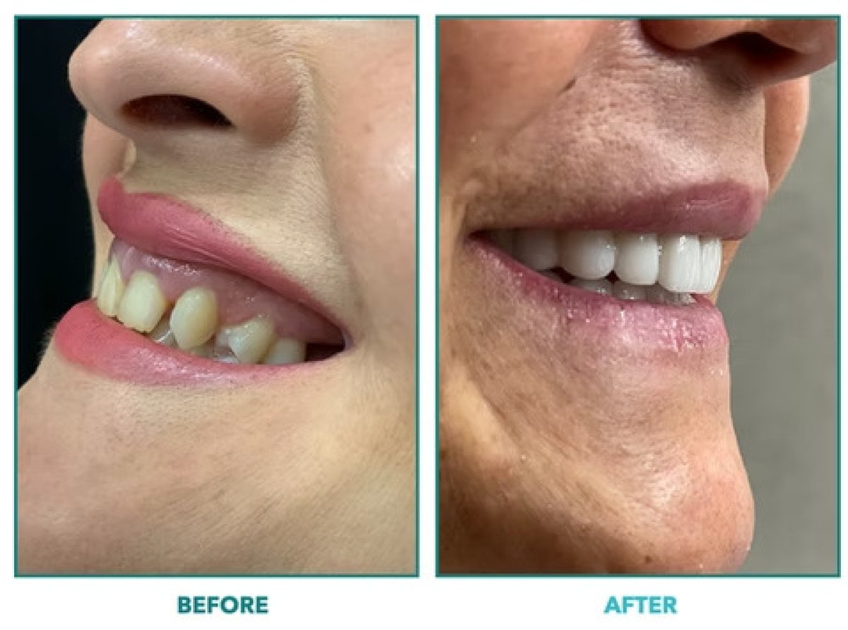 Before and after tooth whitening results – brighter, whiter smile transformation