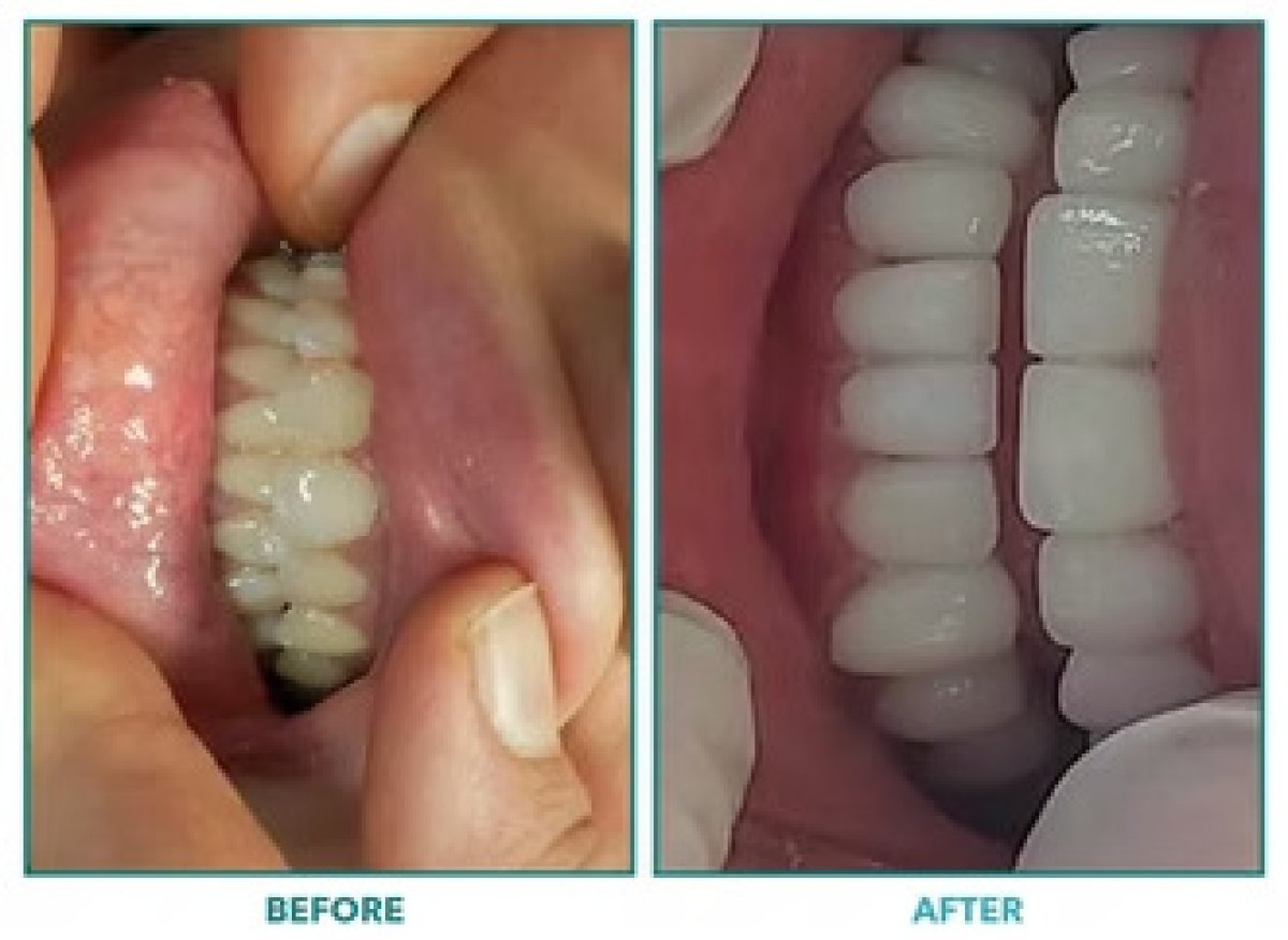 Resultados de blanqueamiento dental antes y después: dientes visiblemente más blancos