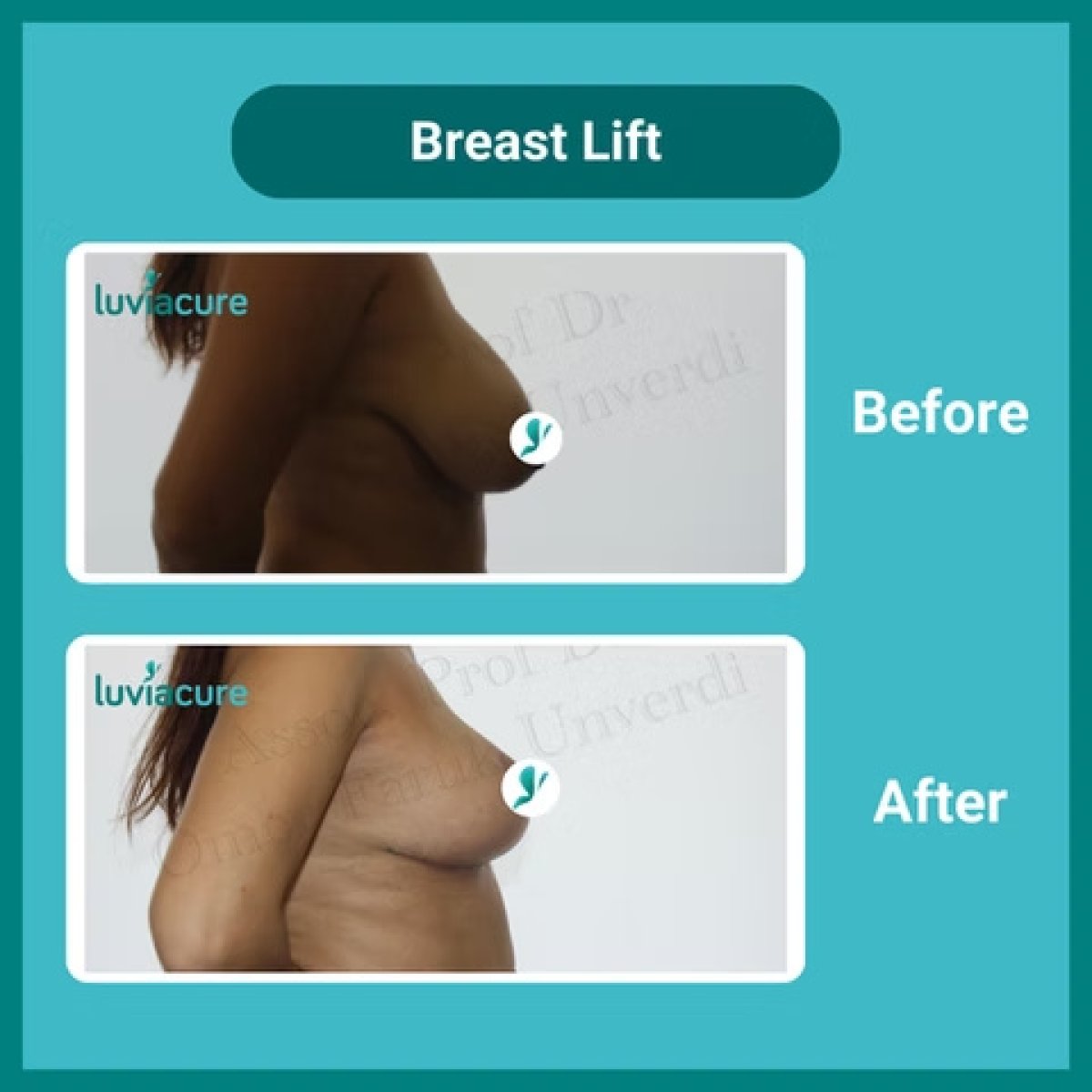 Before and after breast lift results at Luviacure clinic – visible breast contour improvement