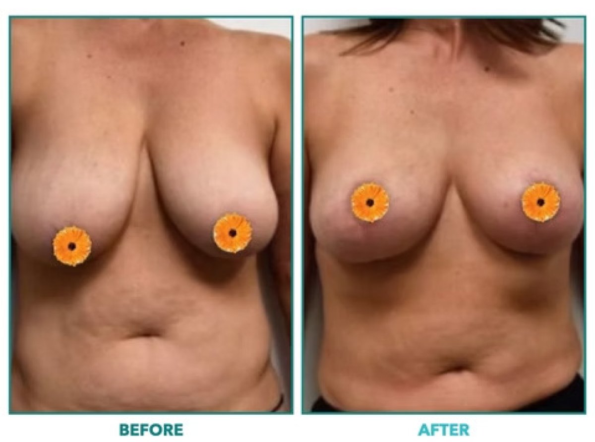 Before and after breast lift results – improved breast shape and firmness after procedure