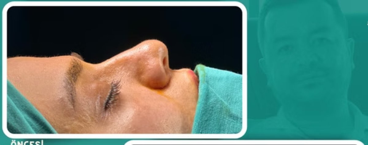 Rhinoplasty before result at clinic, nose reshaping for improved nasal profile