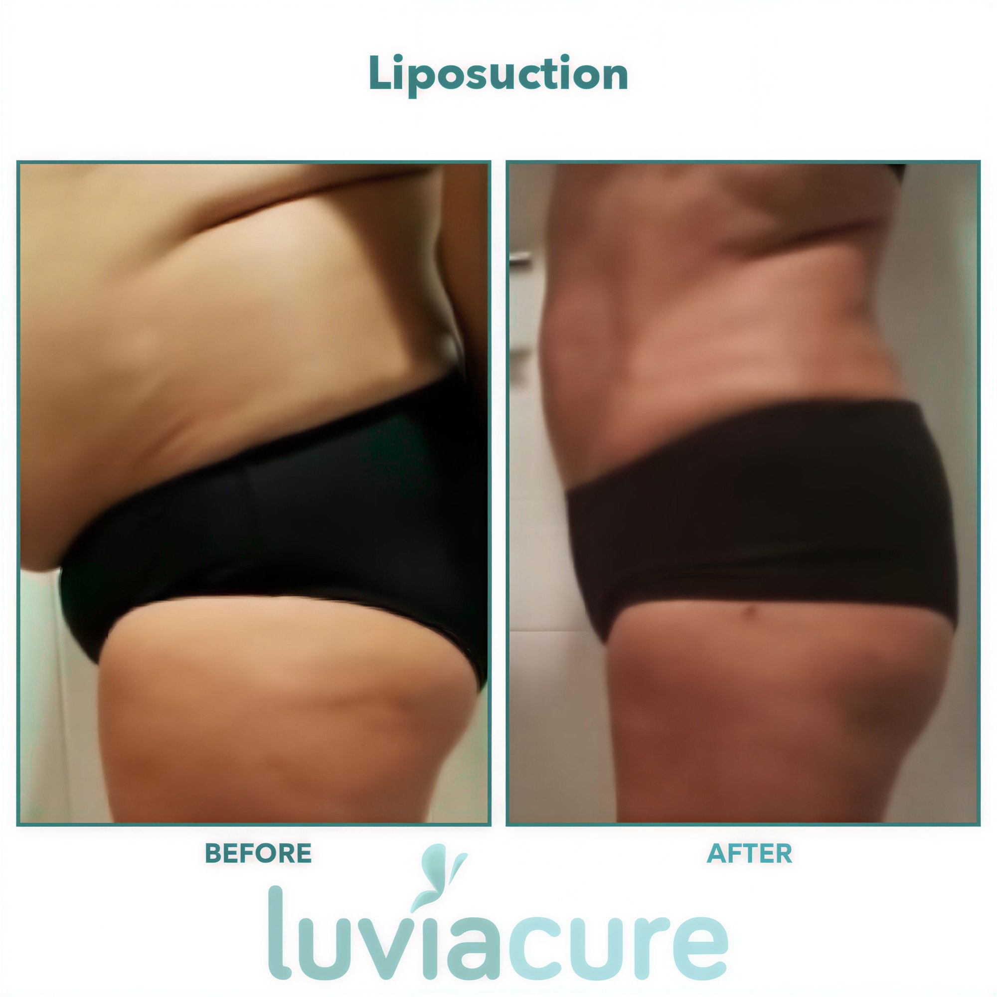 Resultados de liposucción antes y después en Luviacure – mejora visible del contorno corporal