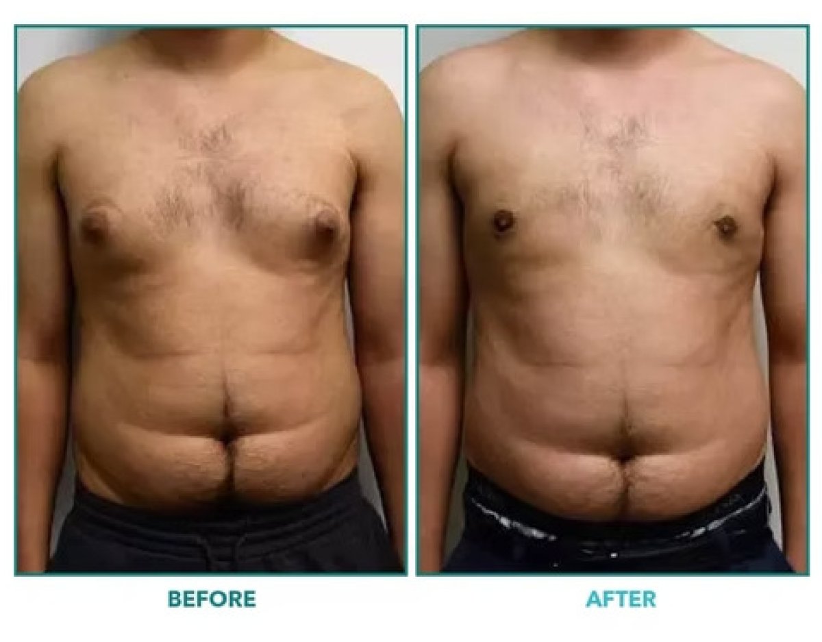 Before and after male liposuction results – visible abdominal fat reduction and contouring