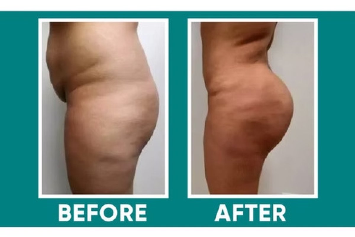 Before and after liposuction results – visible body contour improvement and fat reduction