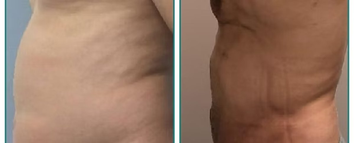 Tummy tuck before and after results – flatter abdomen and improved contour after surgery