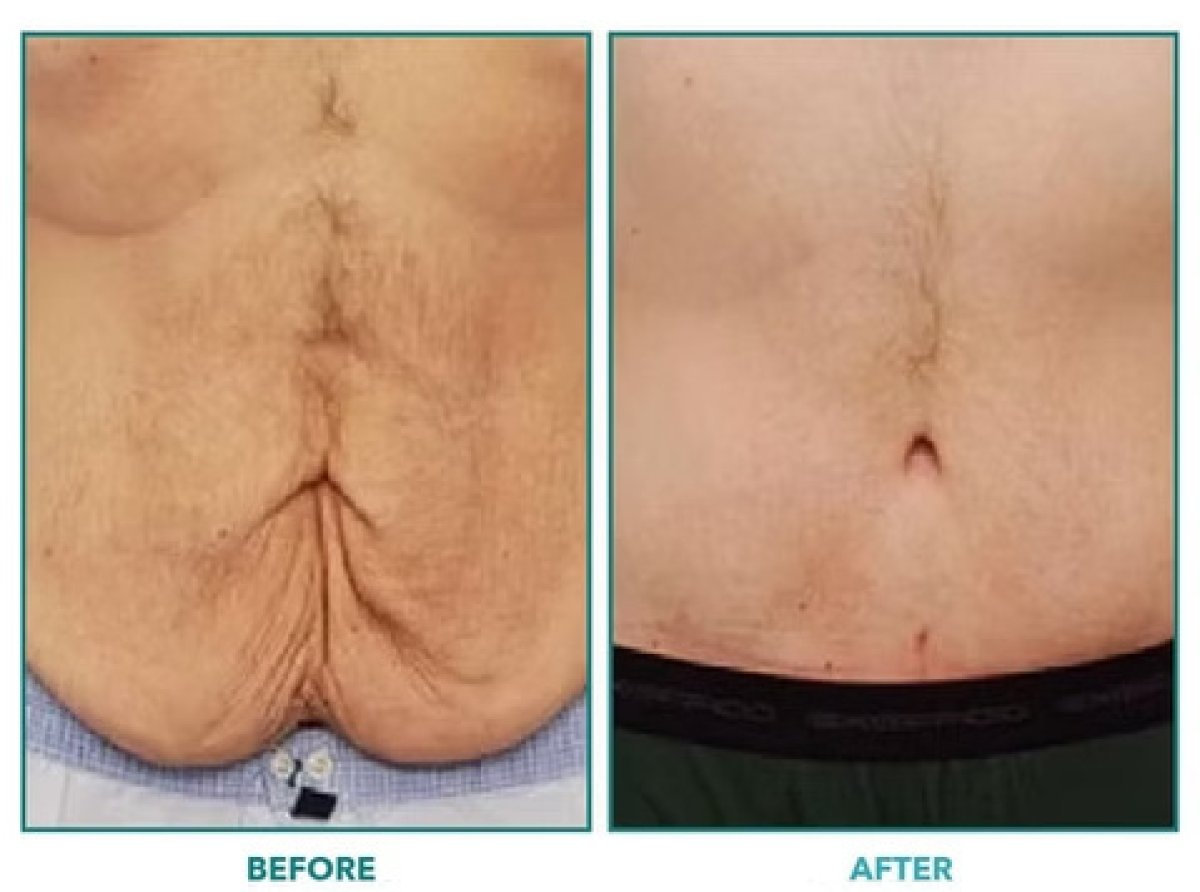 Before and after tummy tuck results – excess skin removal and flatter abdomen improvement