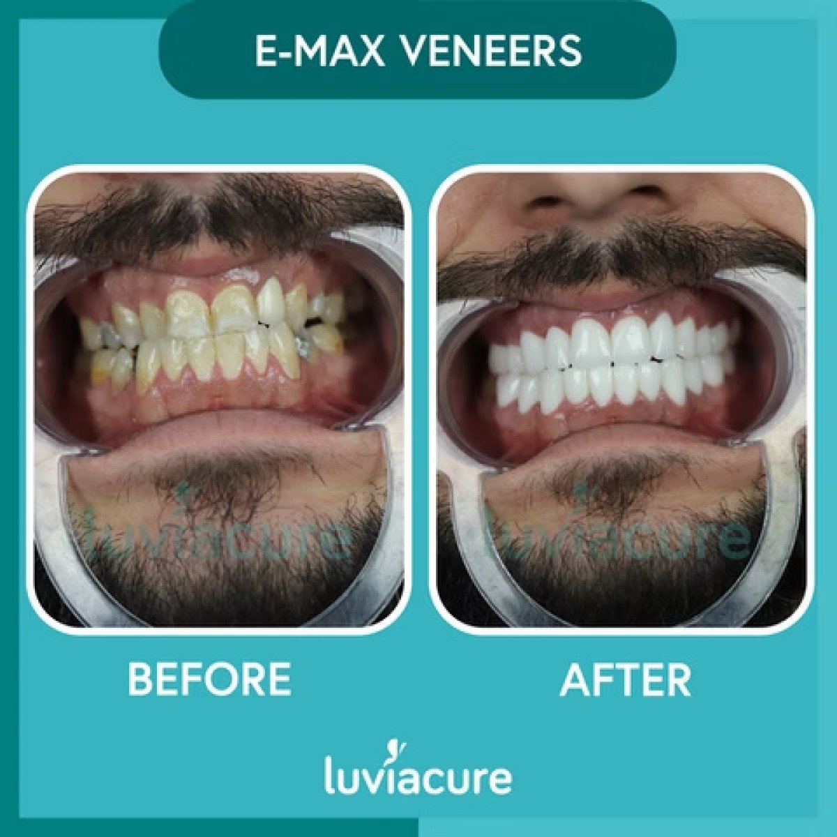 Efekty przed i po licówkach E-max w Luviacure – metamorfoza uśmiechu