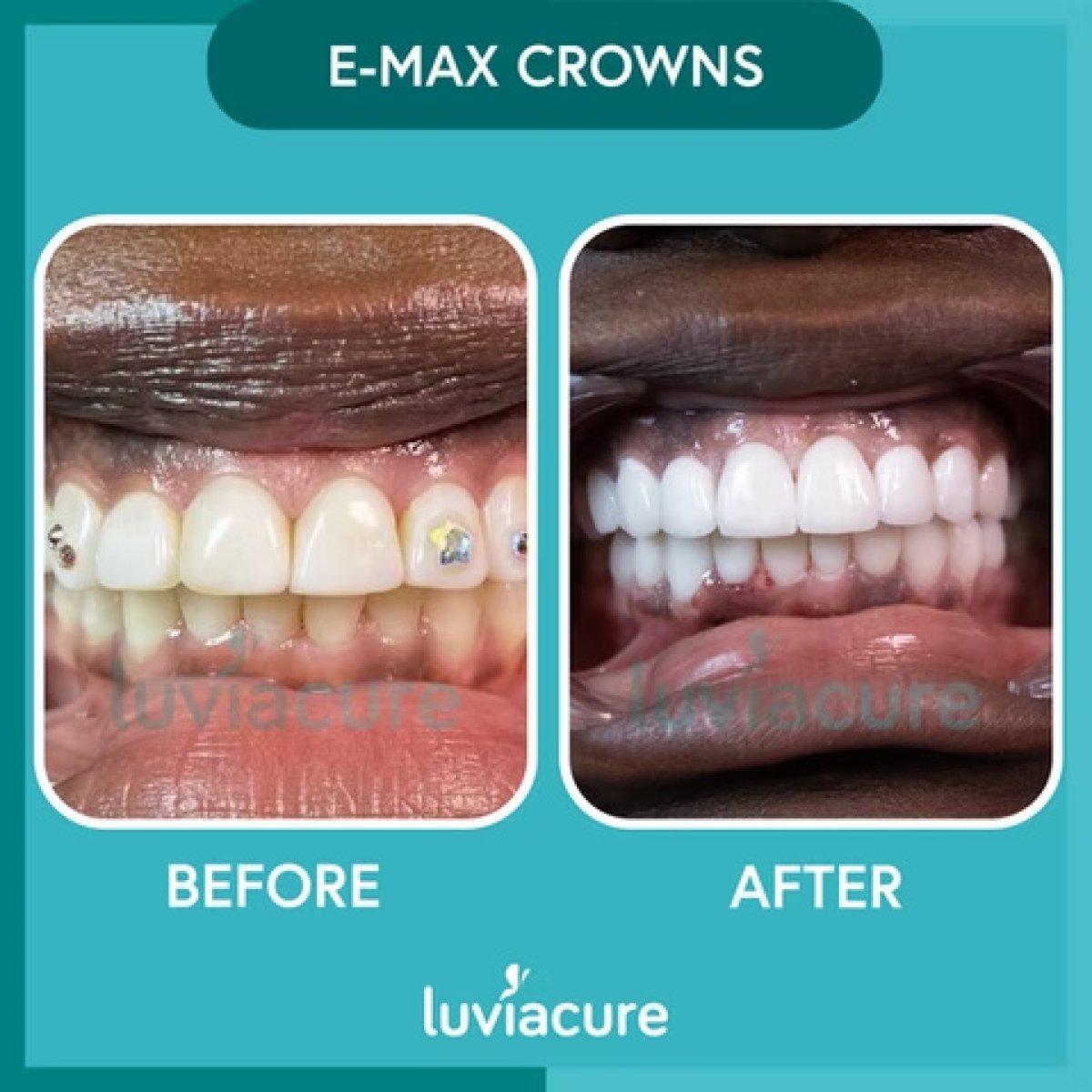 До и после установки коронок E-max в Luviacure, видимый результат улыбки