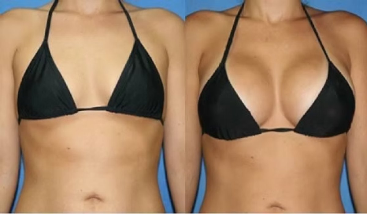 Before and after breast augmentation results – enhanced breast size and contour