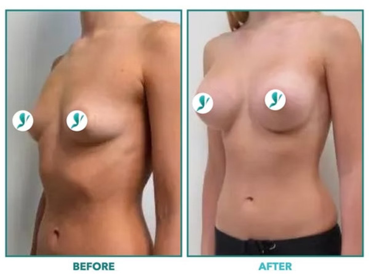 Before and after breast augmentation results – enhanced breast shape and volume