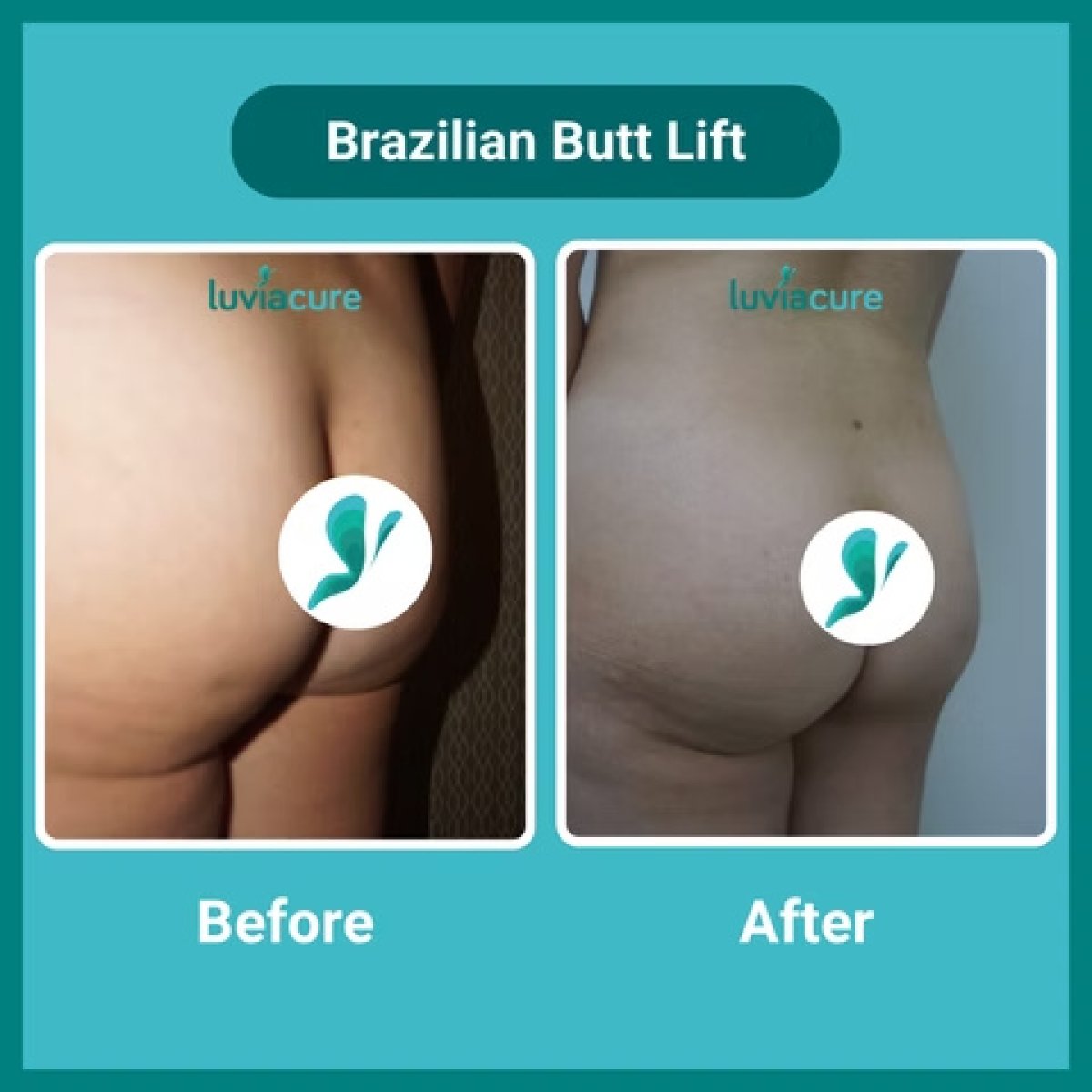 Brazilian Butt Lift before and after results at Luviacure – enhanced buttock contour