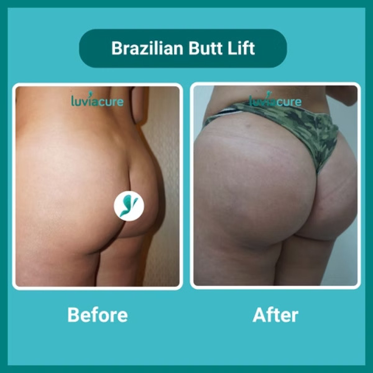 Brazilian Butt Lift before and after results at Luviacure – enhanced buttock contour