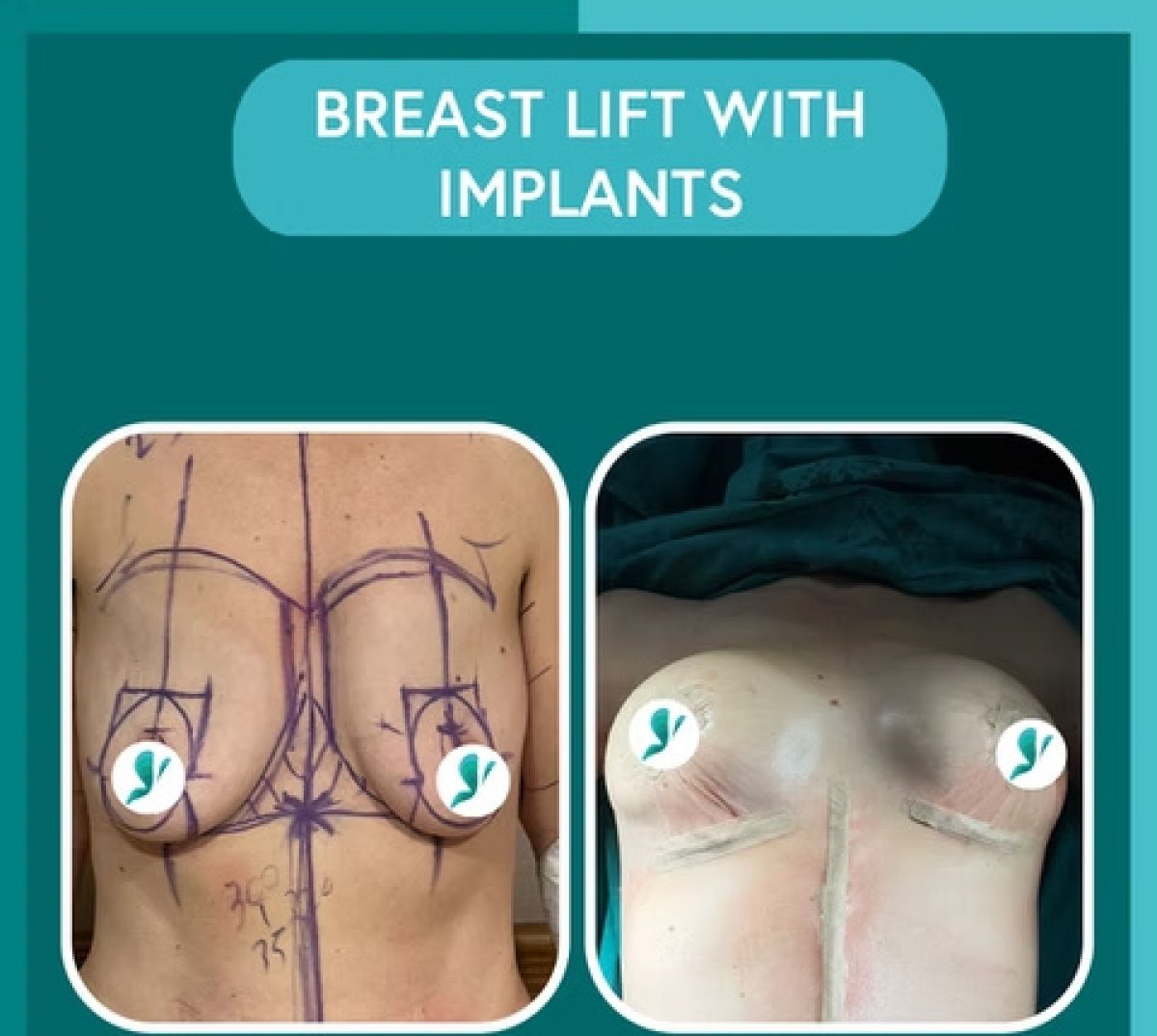 Resultados antes y después de mastopexia con implantes – mejor forma y contorno mamario