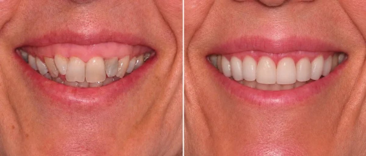 Resultados antes y después de carillas dentales – sonrisa con dientes blancos y parejos