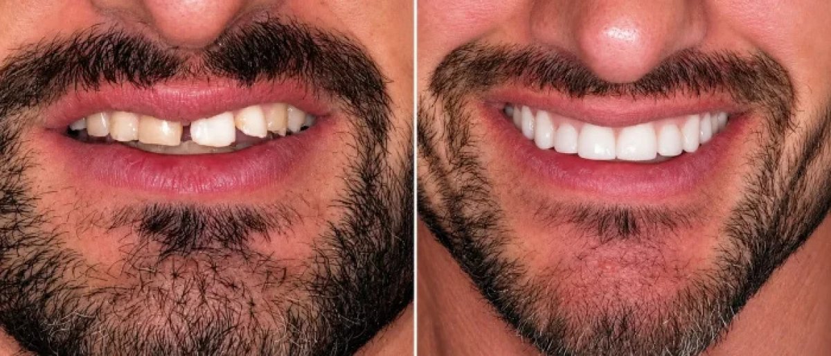 Resultado antes y después de carillas: sonrisa mejorada y dientes más blancos