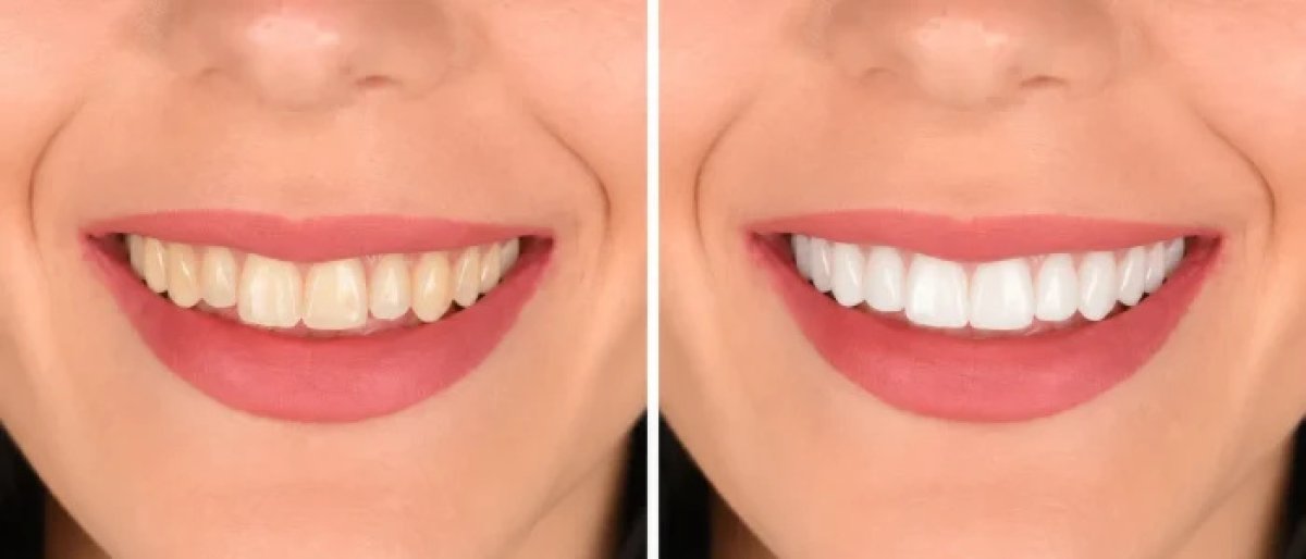 Before and after veneers result – smile transformation with whiter, even teeth