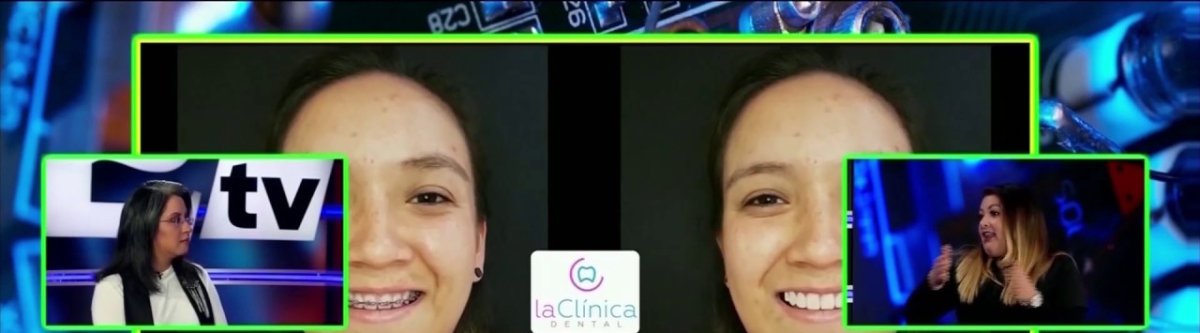 Результаты до и после Invisalign в la Clínica Dental – выравнивание улыбки