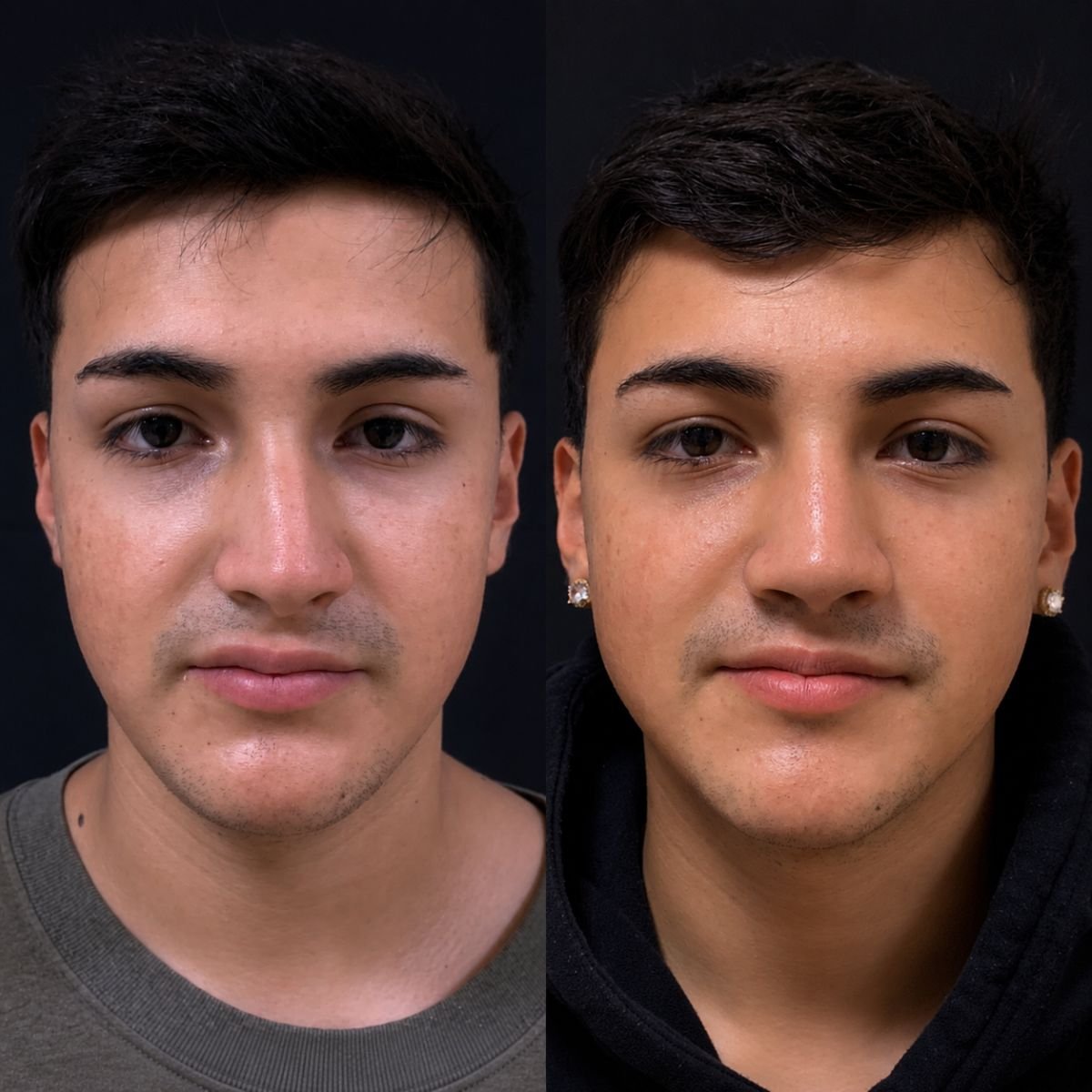 Résultat avant et après rhinoplastie chez Lucio Santos Plastic Surgery, forme du nez améliorée
