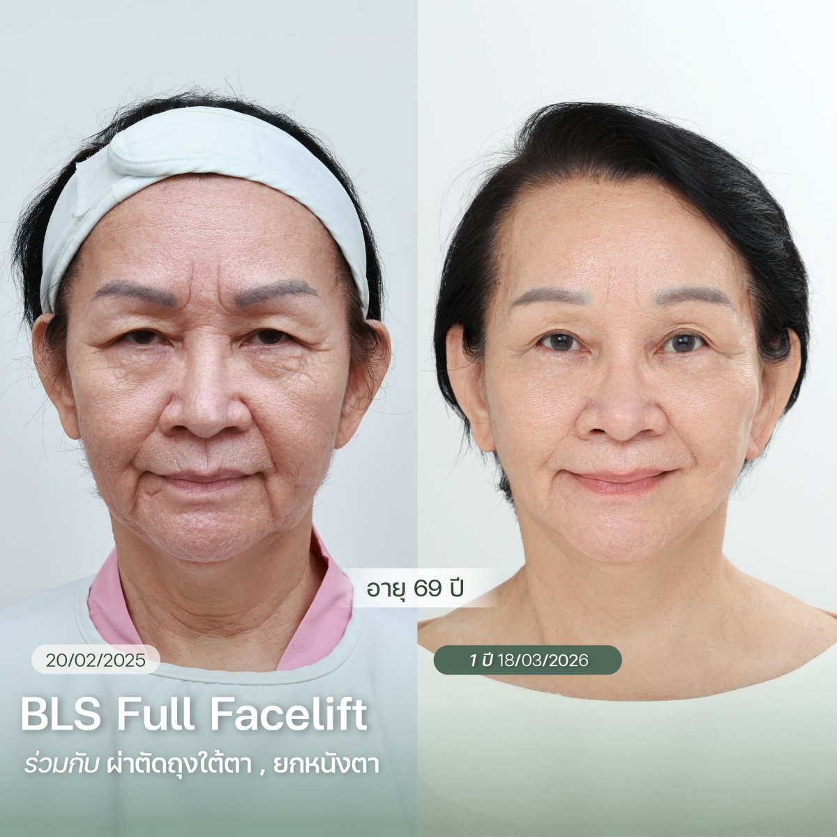 Результаты до и после BLS Full Facelift у женщины 69 лет, видимое омоложение лица