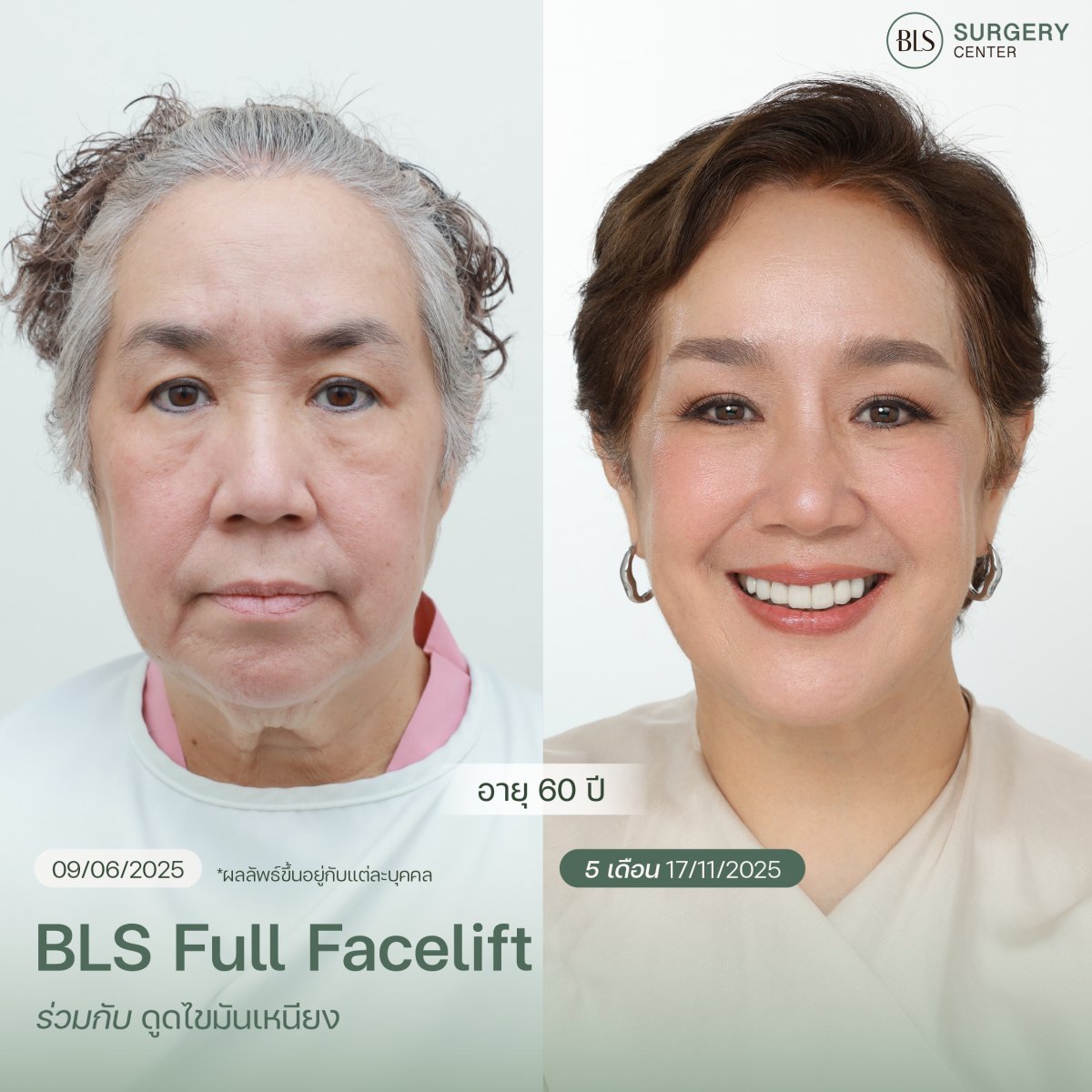 نتائج شد الوجه قبل وبعد في مركز BLS للجراحة – تجديد واضح للوجه