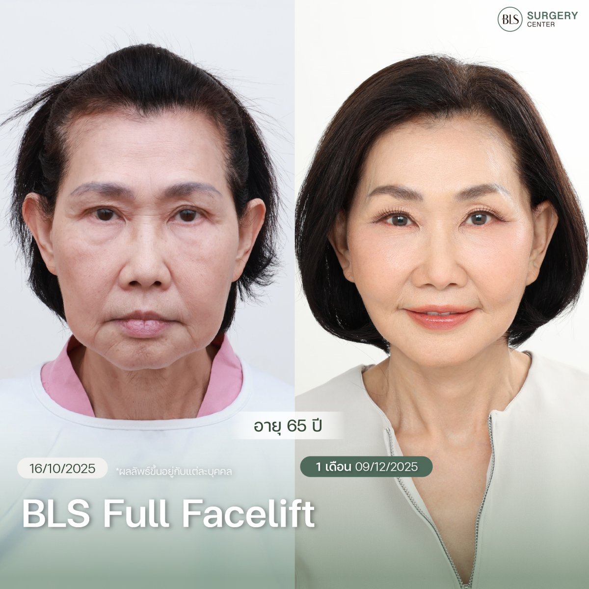 نتائج شد الوجه الكامل BLS قبل وبعد – تجديد شباب الوجه وبشرة أكثر نعومة في BLS