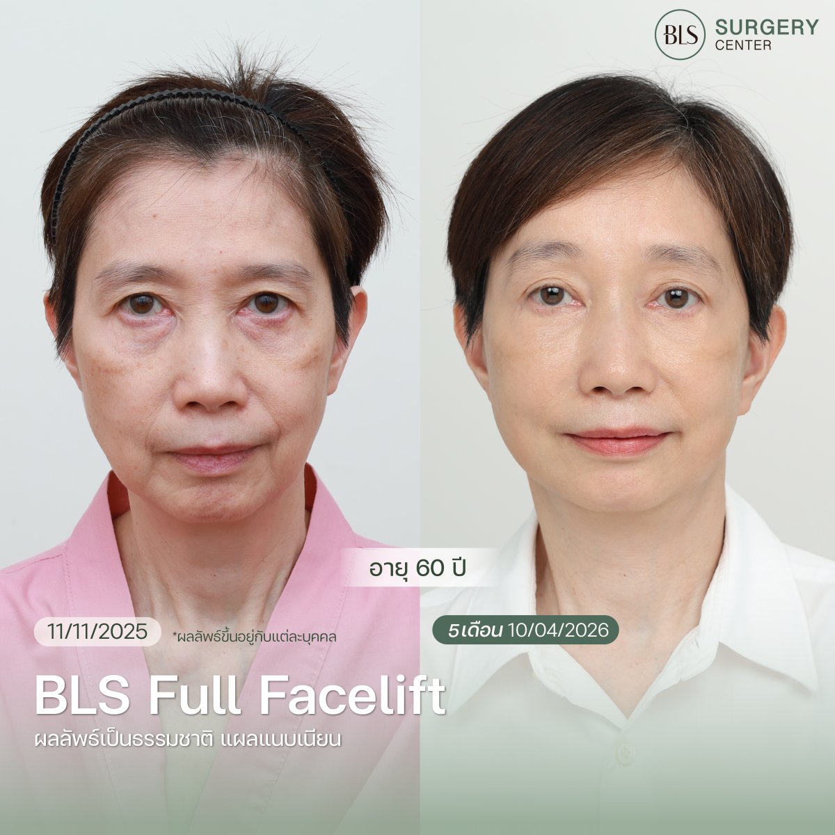 Результаты до и после фейслифтинга в BLS Surgery Center – видимое омоложение лица
