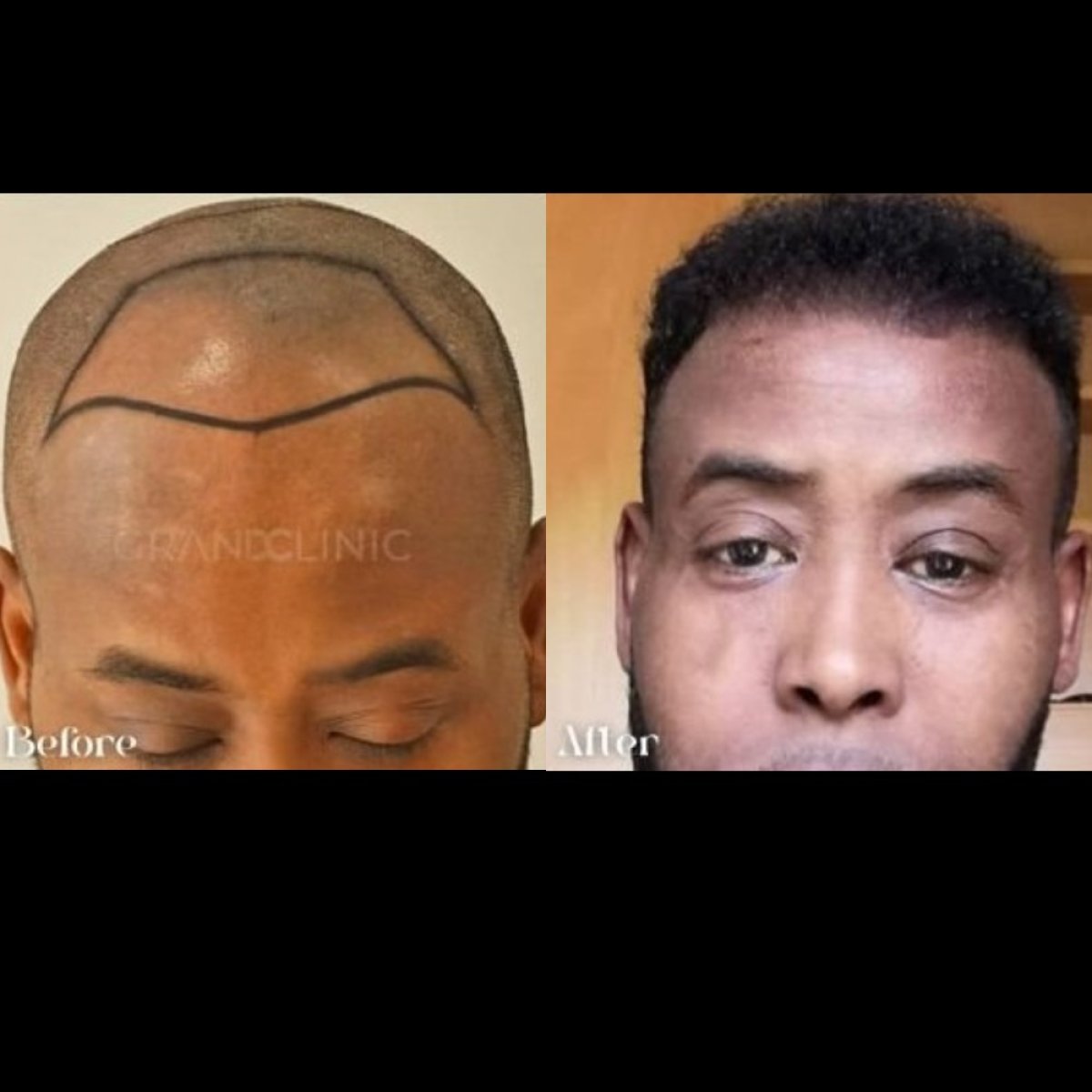 نتائج زراعة الشعر قبل وبعد في Grand Clinic – استعادة خط الشعر وكثافة الشعر