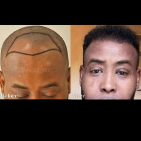 Turkey Hair Transplant (Maximum Grafts) All Included - photo 6