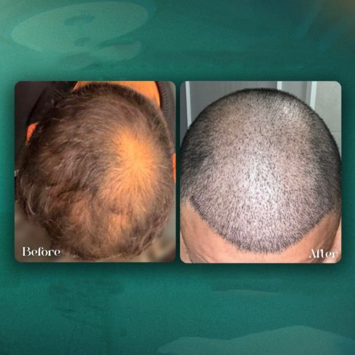 نتائج زراعة الشعر قبل وبعد في Grand Clinic – استعادة كثافة الشعر على فروة الرأس