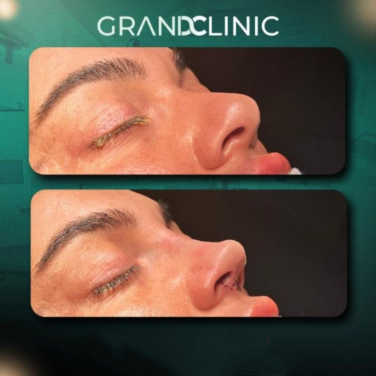 Resultado de rinoplastia antes y después en Grand Clinic, mejora de forma y perfil nasal