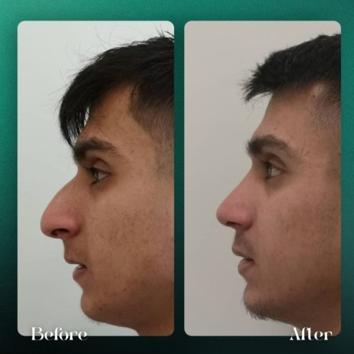 Before and after rhinoplasty results at Grand Clinic, improved nose shape and profile