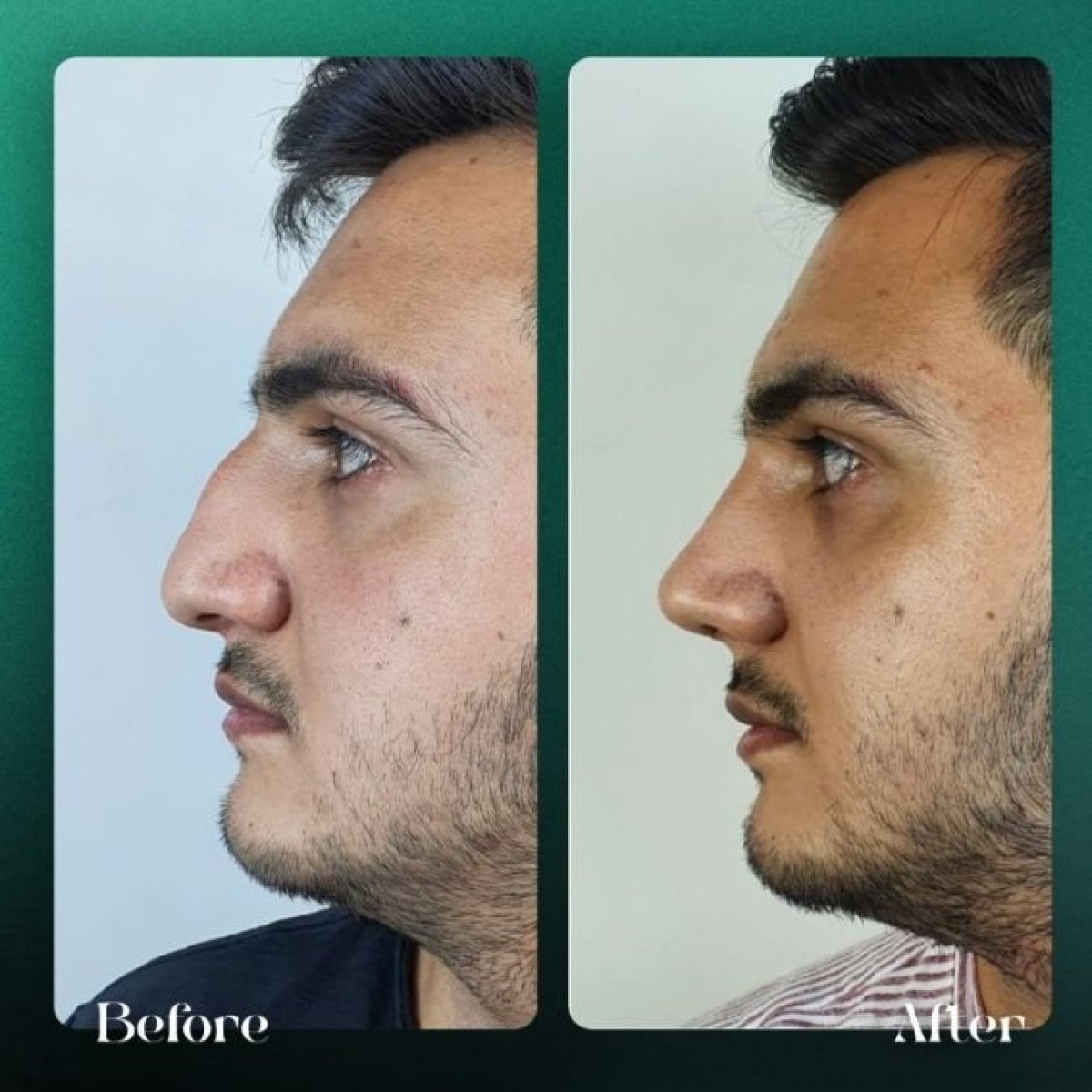 Efekty przed i po rhinoplastyce w Grand Clinic, poprawiony kształt i profil nosa