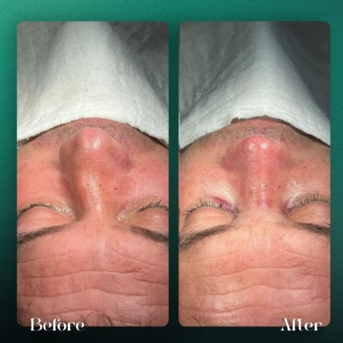Resultados de rinoplastia antes y después en Grand Clinic, mejora de forma y simetría nasal
