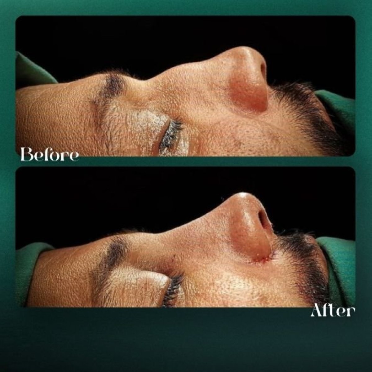 Resultados de rinoplastia antes y después en Grand Clinic, mejora de forma y perfil nasal