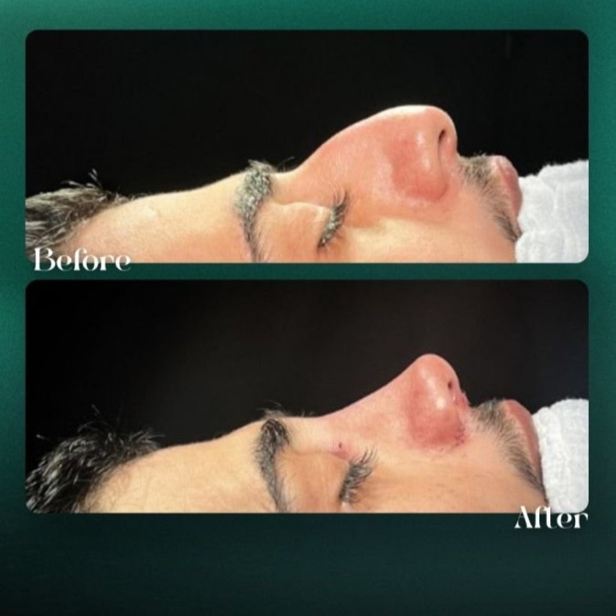 Before and after rhinoplasty results at Grand Clinic, improved nose shape and profile