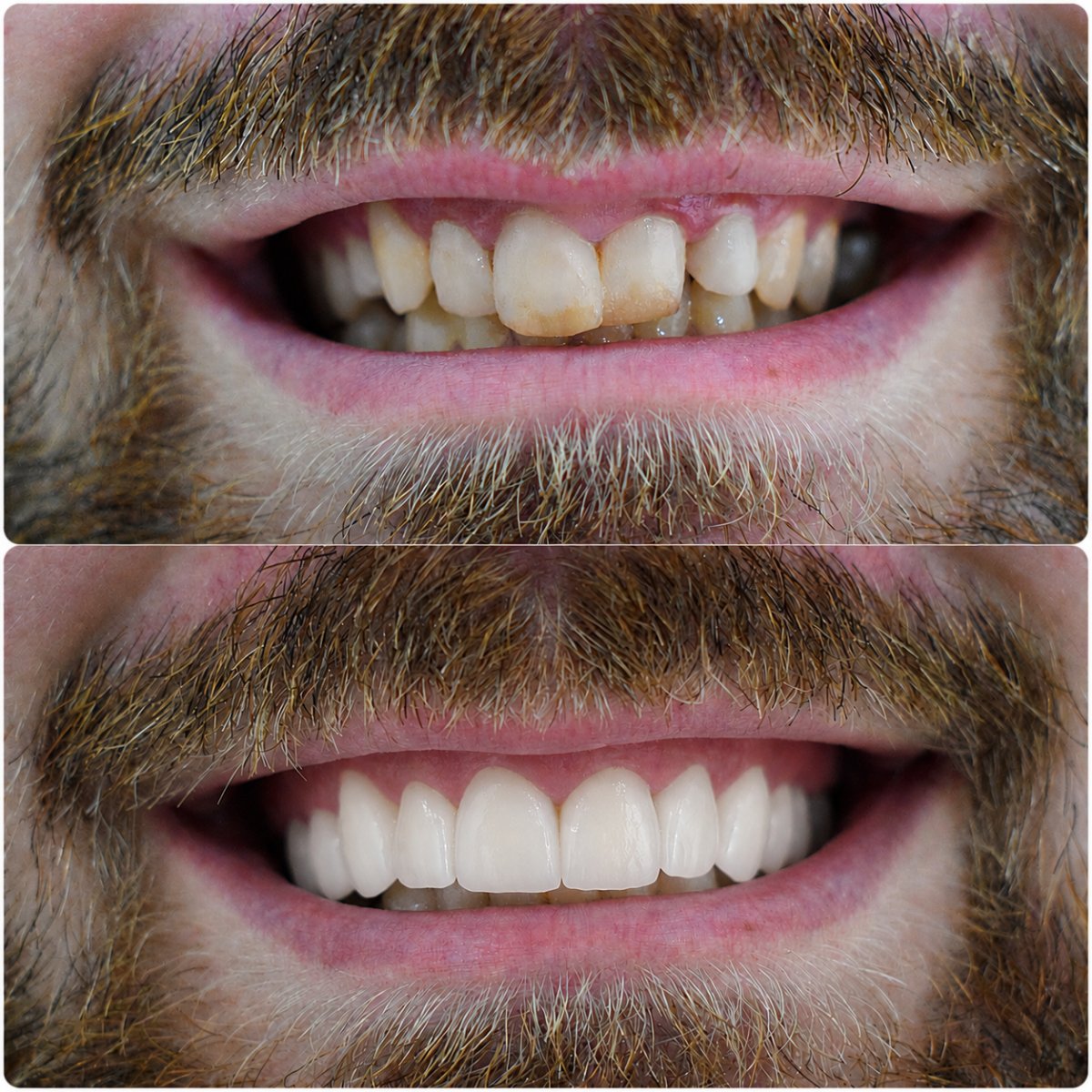 نتائج قبل وبعد تركيب تيجان الزركونيا في عيادة سبانداريشفيلي، تجميل الابتسامة