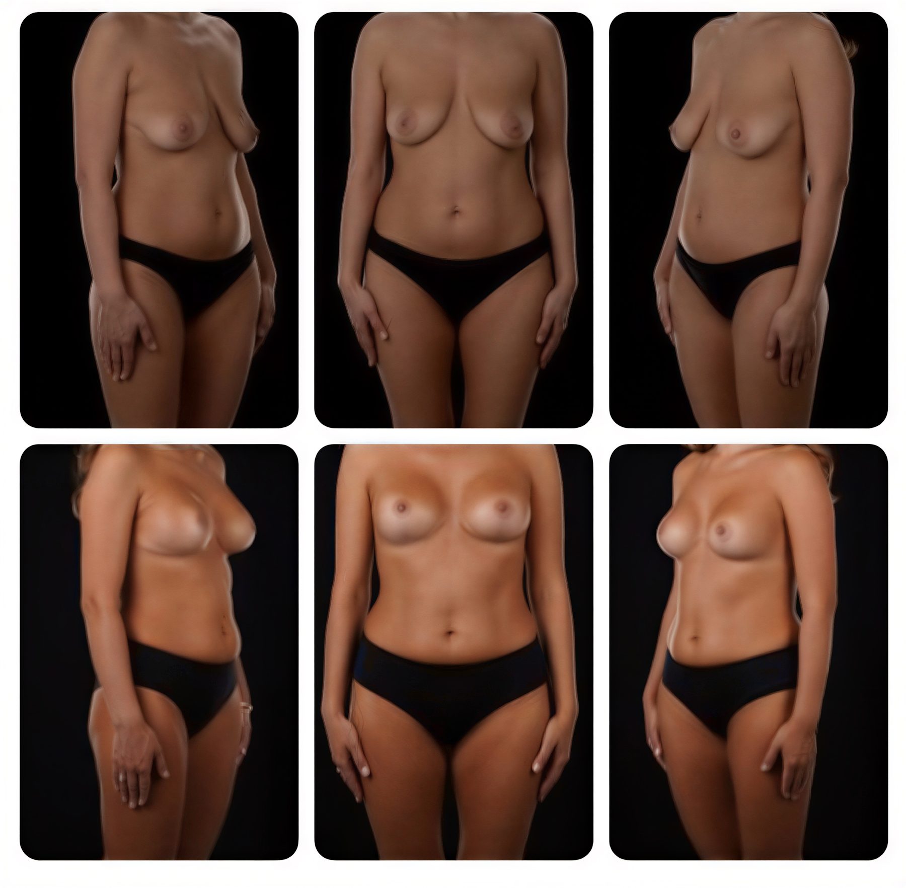 نتائج شد الثدي قبل وبعد في Yurchenko Plastic Surgery Team Kyiv، تحسين الشكل