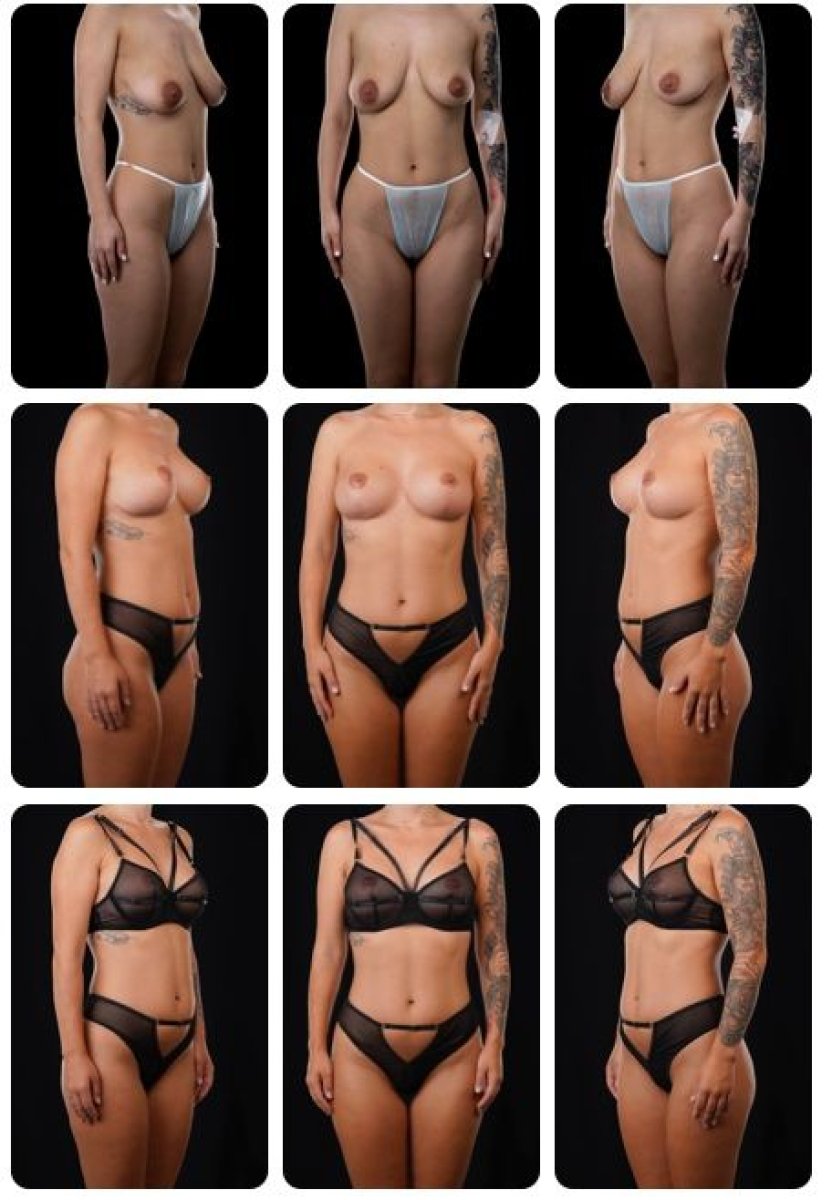 Résultats avant/après lifting mammaire chez Yurchenko Plastic Surgery Team Kyiv, contour amélioré